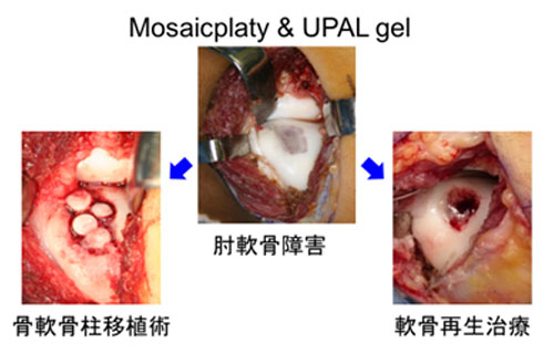 アルギン酸ゲルを用いた軟骨再生治療