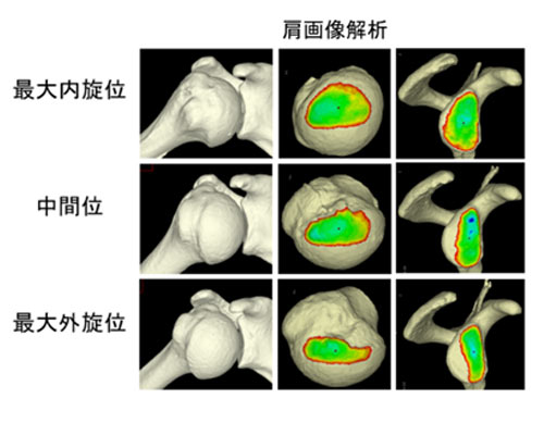 画像解析手法を用いた肩関節疾患の病態解明