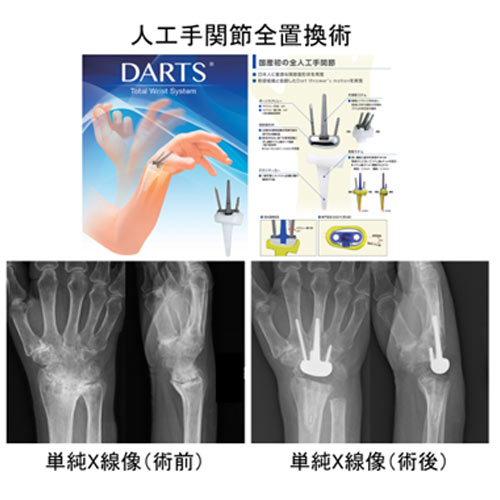 “DARTS人工手関節”の実用化と普及