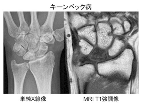 キーンベック病における病態および術式の検討