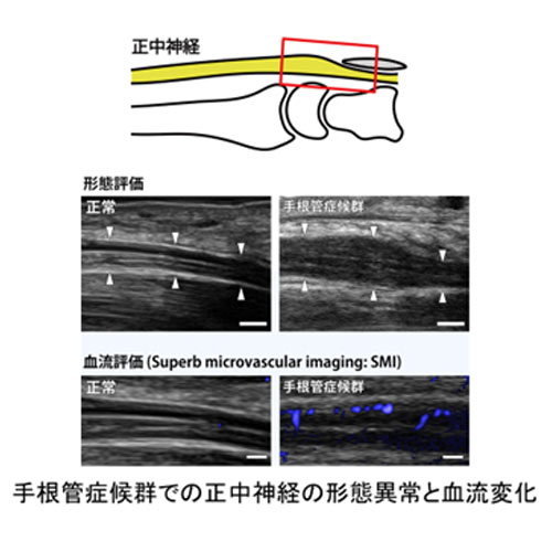 絞扼性末梢神経障害における神経内微小血行動態の解析