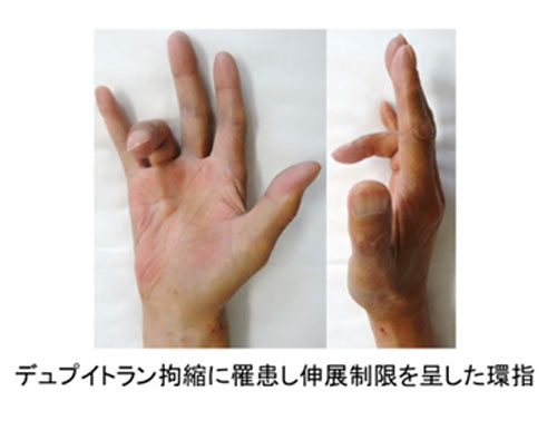 デュピュイトラン拘縮における手掌腱膜の線維化制御機構の解明