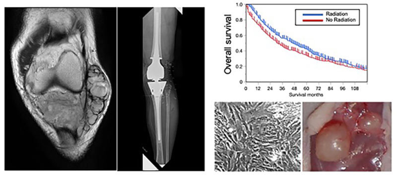 （左）関節内軟部肉腫に対し関節外切除＋腓腹筋弁での組織再建を施行 （右上）癌データベースによる疫学研究、高齢者において放射線照射が生存を改善することを証明 （右下）軟部肉腫細胞株を免疫不全マウスに移植し、新規薬物療法を効果判定