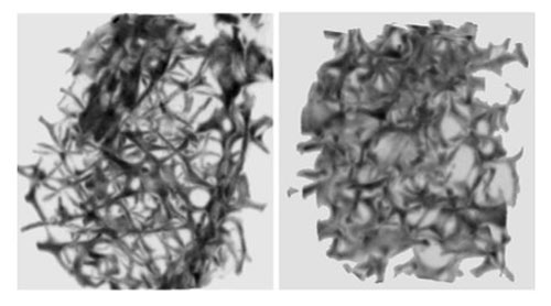 ヒト腸骨海綿骨生検サンプルのマイクロCT画像。左は長期間ビスフォスフォネートで治療してもグルココルチコイド誘発性骨粗鬆症患者の骨は、右の健常者と比べて骨梁が細く、構造が粗であることを示している