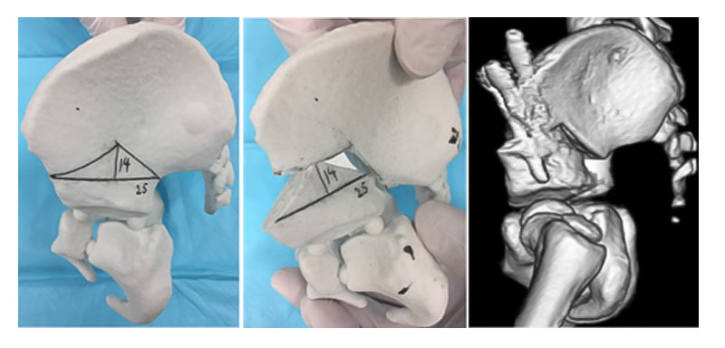 発育性股関節形成不全 (DDH)に対する低侵襲骨盤骨切り術（AIO）