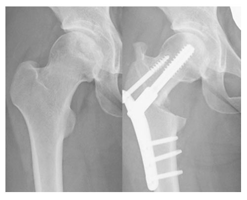 特発性大腿骨頭壊死症、大腿骨頭軟骨下脆弱骨折、急速破壊型股関節症