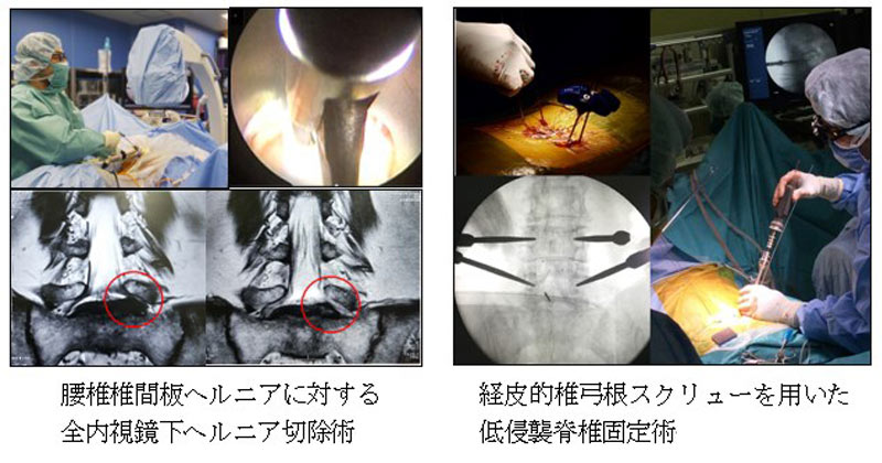 脊椎低侵襲手術・脊椎全内視鏡手術