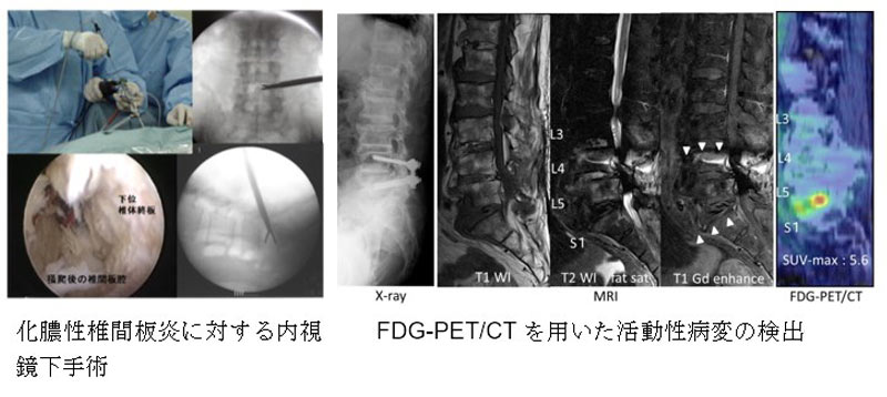 脊椎感染症に対する新しい治療戦略の確立