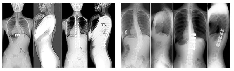 (左)4D解剖学的脊柱再建術　　(右)Kaneda Anterior Spinal Systemによる前方矯正固定術