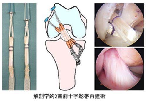 膝靱帯再建術