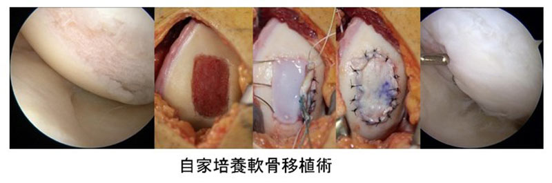 軟骨再生治療