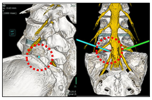 3D腰神経MRI/腰椎CT fusionイメージを用いた全内視鏡下腰椎椎間板ヘルニア手術シミュレーション